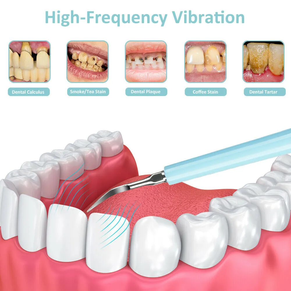 Sonic Plaque Remover Oral Care Dental Calculus Remover (USB power supply)